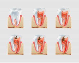 cavity      henritze dental group