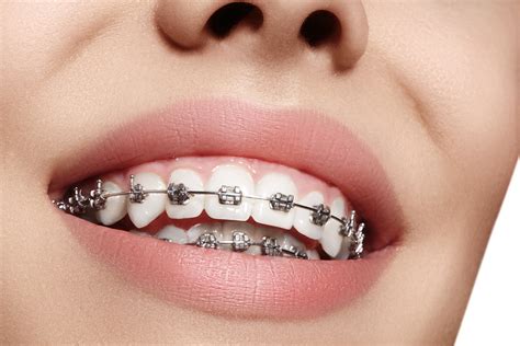tipos de brackets clinica dental moraleja smile alcobendas