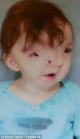 violet pietrok now smiling after major surgery and 3d printing help reshape her face daily