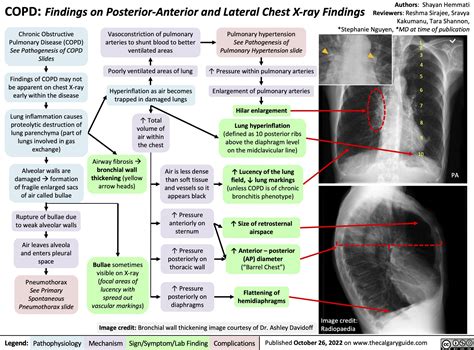 copd findings  posterior anterior  lateral chest  ray findings