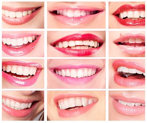 estetica dental  diseno de sonrisa  carillas esteticas