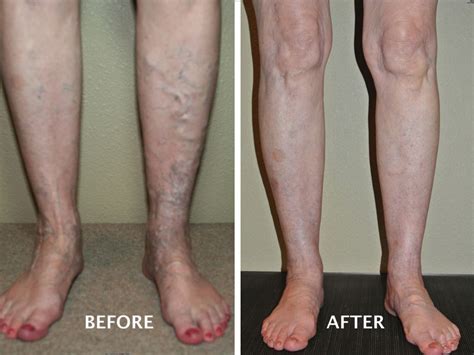 How Much Do You Know About Varicose Veins Advanced Vein Therapy