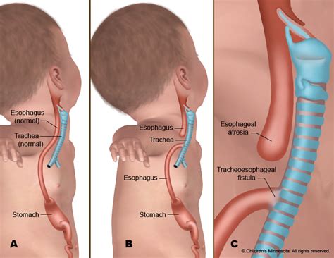 esophageal atresia symptoms surgery childrens minnesota