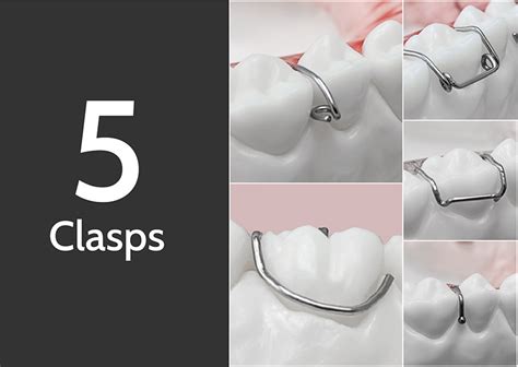 clasps universal orthodontic lab