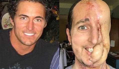 Half Of This Man’s Face Was Destroyed By Cancer You Won’t Believe What