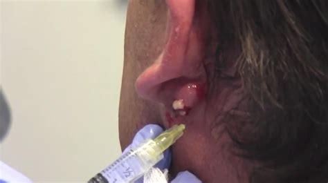 lump in earlobe cancer new pimple popping videos