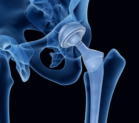 long term precautions  hip replacement surgery  restrictions  limitations