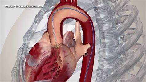 Uw Using New Non Invasive Heart Valve Replacement Procedure Youtube