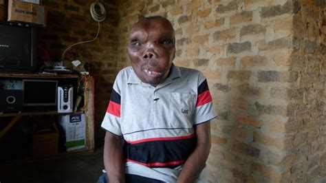 man  severely deformed head   crowned ugandas  unusual  person