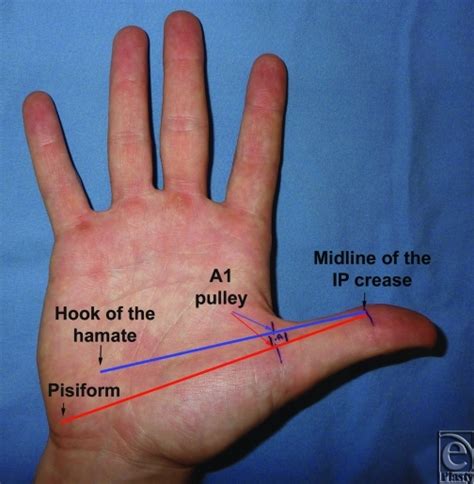 figure 1 safe treatment of trigger thumb with longitudinal anatomic