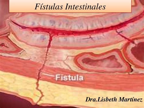 fistulas intestinales
