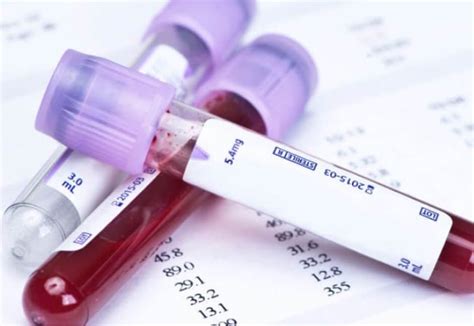 pruebas de diagnostico por colestasis del embarazo icp care