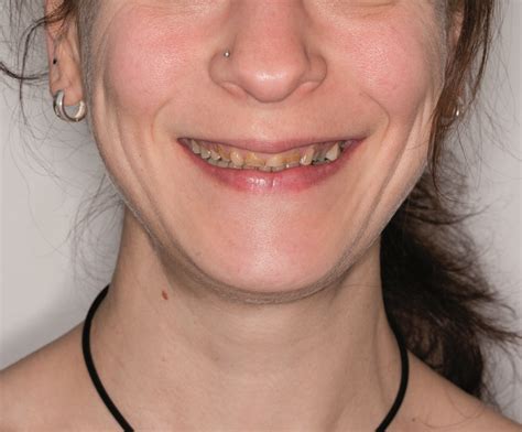 dentale restauration bei bulimie betroffenen durch digital unterstuetzte