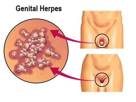 genital herpes symptoms causes and treatment