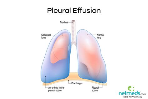 Pleural Effusion Causes Symptoms And Treatment Netmeds