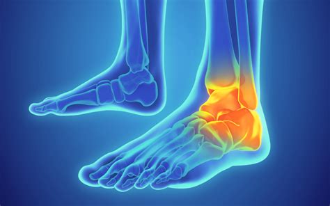 ankle sprains ankle injuries symptoms  treatments