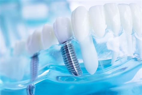 woodland hills dentist offers  types  dental implants woodland hot
