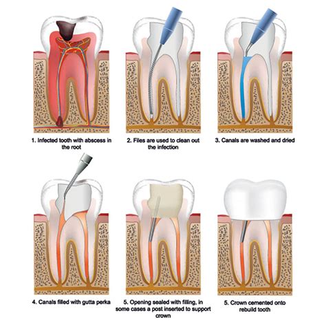 root canal specialist   root canal