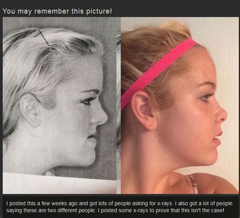 Before And After Jaw Surgery Others