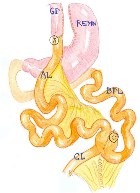 The Typical Old Fashioned Roux En Y Gastric Bypass With