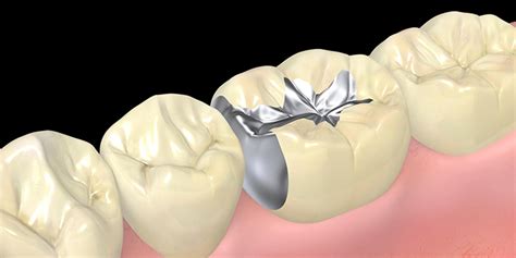 歯の詰め物が取れる原因と取れた後にしてはいけないこと 浦和の矯正歯科｜くろさき歯科