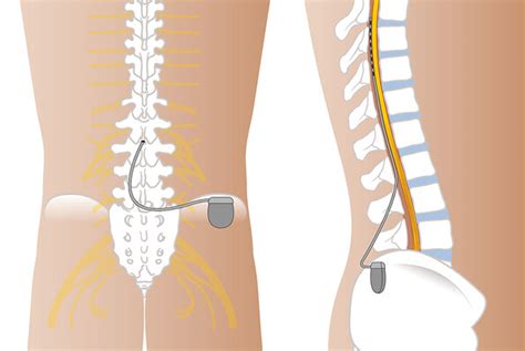 spinal cord stimulation   treatment  peripheral neuropathic