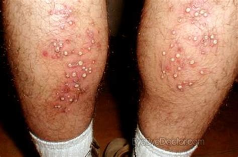 hot tub rash pictures symptoms treatment cure causes