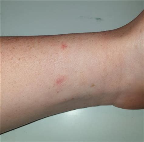 rash  bumps  wrist  due wristband forerunner   runningmultisport