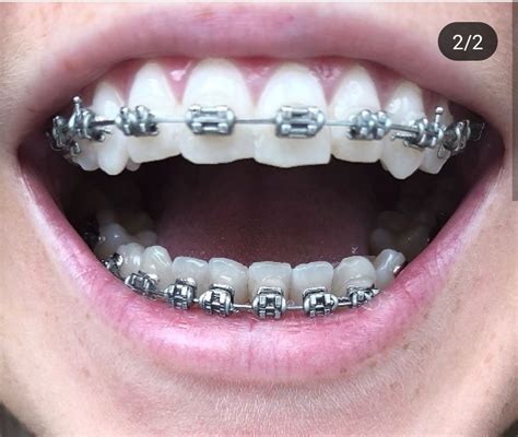 Pin De Jamie Richie En Braces And Retainers Orthodontics Brackets
