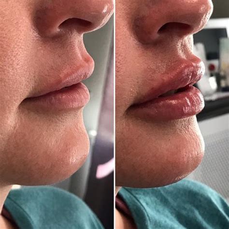 our new lip filler restylane kysse transformed med spa of frederick