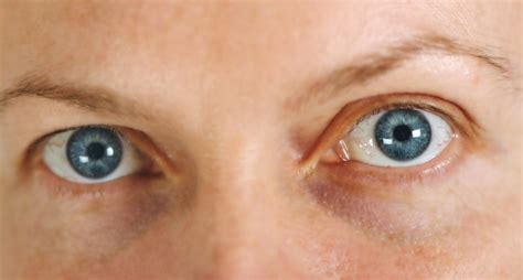 What Are The Most Common Eye Problems Among People