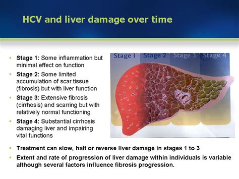 Module 3 Liver Damage And Course Of Hcv Infection