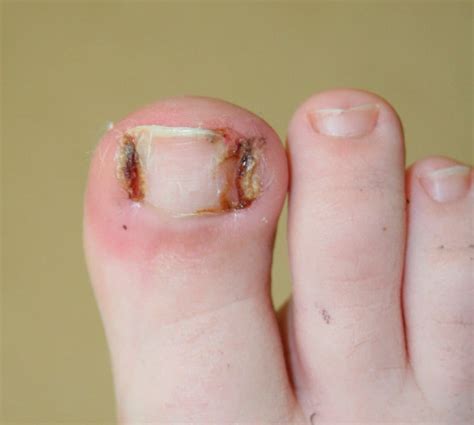 Infected Nail Bed Before And After Photos Of Laser Nail