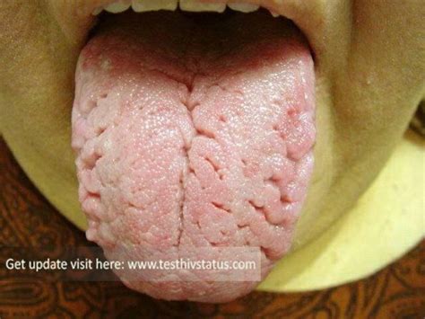 hiv rash tongue gallery