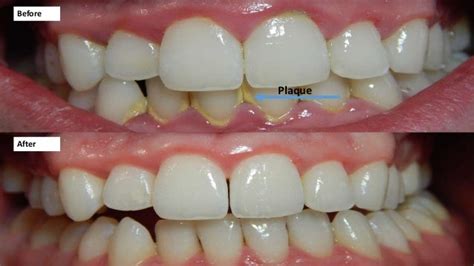 Dental Plaque Explained