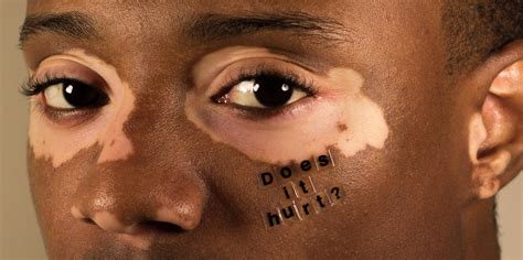 photographer  documenting  realities  living  skin conditions