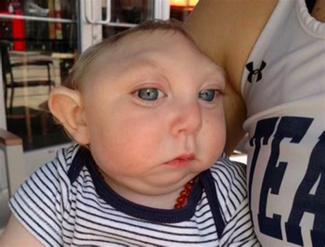 jaxon strong was born with most of his skull missing