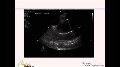 tte  aortic dissection youtube