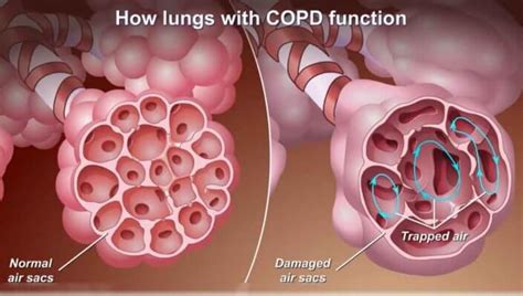 Understanding Copd And How Medical Oxygen Can Help