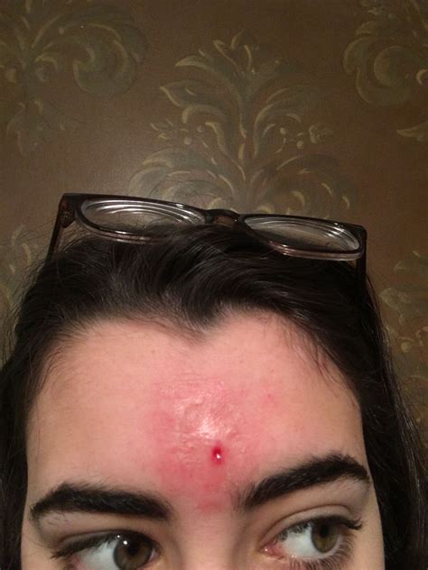 whats     forehead general acne discussion acneorg