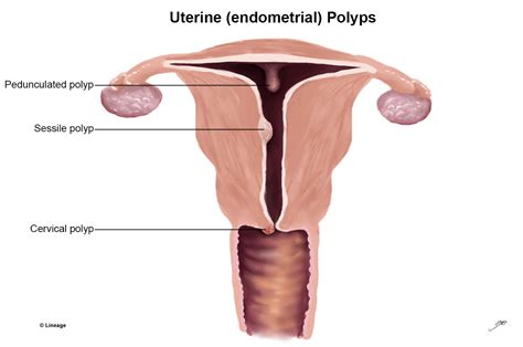 endometrial polyp reproductive medbullets step 1
