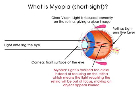 myopia short sight myopia    short sight   bhavin shah  kids