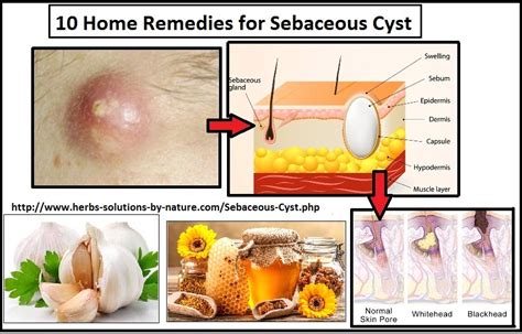 10 home remedies for sebaceous cyst natural treatment herbs solutions