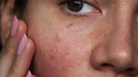 skin mites contribute  skin redness gladskin