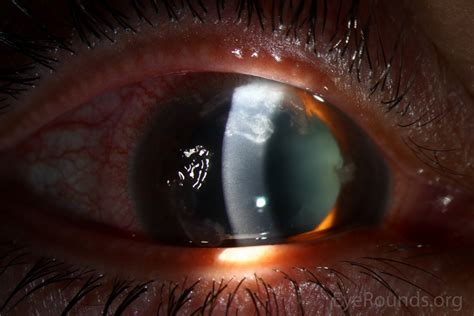 nocardia farcinica keratitis   contact lens wearer