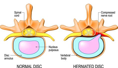 intervertebral discs structure function  disorders spine info