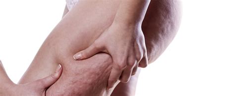 what cellulite treatments work popsugar fitness
