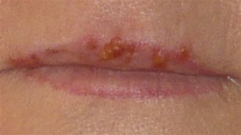 bumps on lips causes treatment pictures 2018 updated