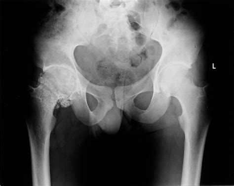 Synovial Osteochondromatosis Of The Hip The Journal Of Rheumatology