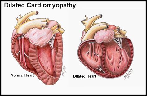 cardiomyopathy causes symptoms diagnosis treatment